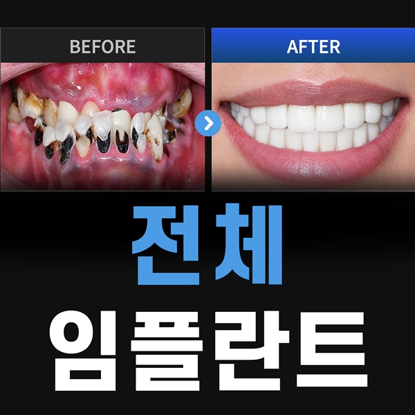 4.수많은 전체임플란트 치료 경험으로 정확하고 꼼꼼하게 치료합니다.jpg