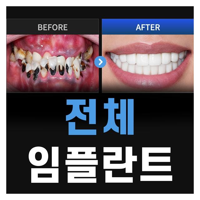 수많은 전체임플란트 치료 경험으로 정밀하고 꼼꼼하게 치료합니다.